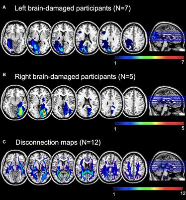 The effects of occipital and parietal tDCS on chronic visual field defects after brain injury
